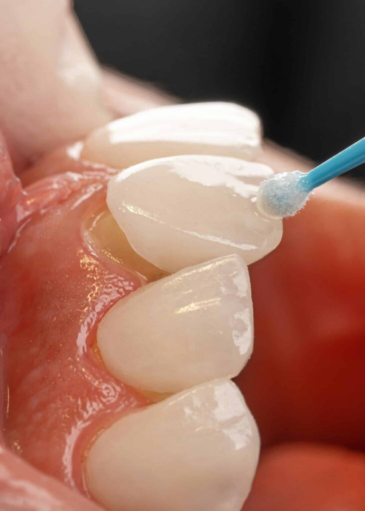 Close-up of dental veneers being bonded to teeth at a Lemont cosmetic dentistry practice.